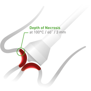 Máy đốt lạnh cổ tử cung
